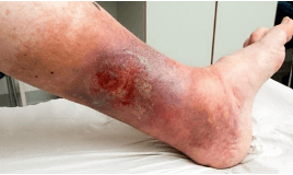 Opioidbaserat dermalt projekt